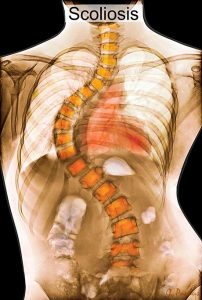 Scoliosis