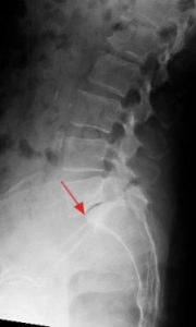Spondylolisthesis Figure 1