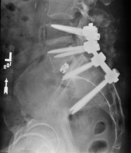 Spondylolisthesis Figure 4