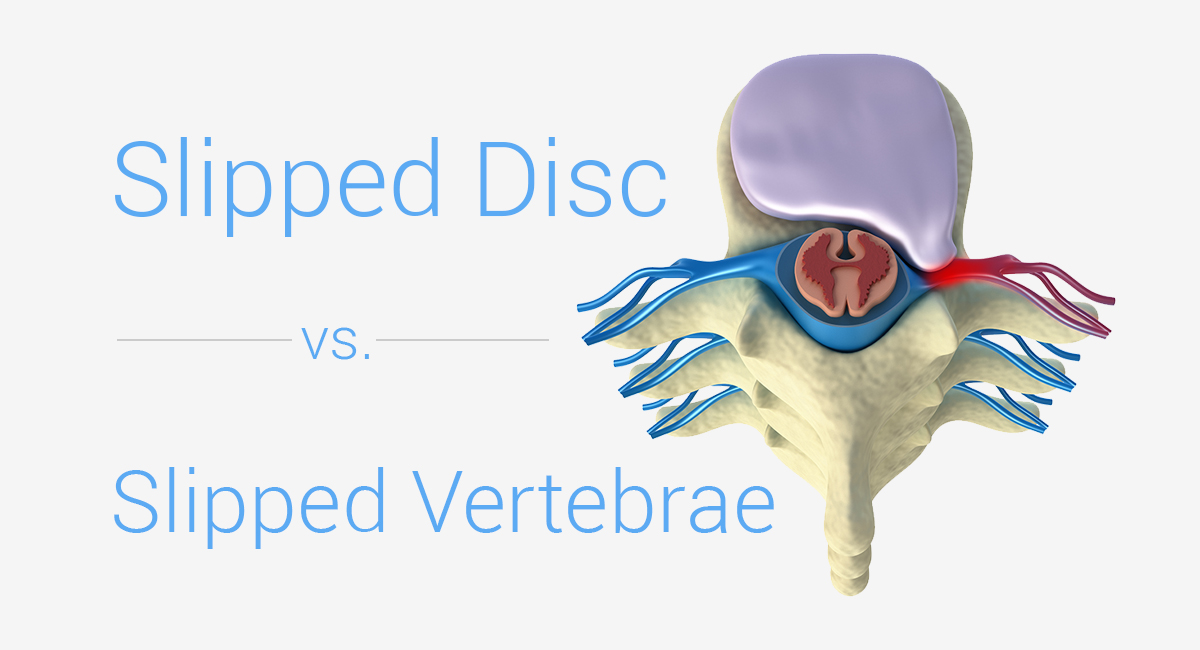 Slipped Disc vs Slipped Vertebrae