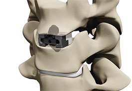 acdfspine