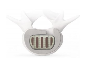 VTI – Interfuse S Interbody device, implanted to facilitate fusion between two verterbral bones.