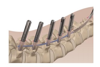 Alphatec Spine – Illico MIS Screws and towers used to fixated the vertebrl bodies to facilitate fusion.