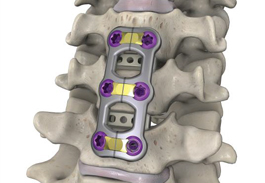 Alphatec -Trestle luxe® – anterior cervical plating system