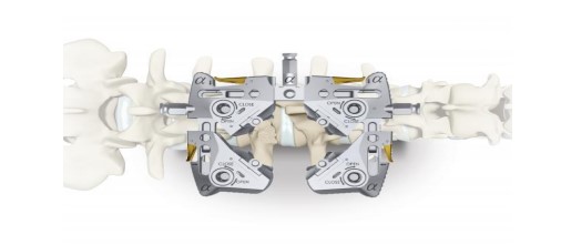 An Alphatec Illico retractor is used to create a passageway for the surgeon to reach the problem area of the lower back.