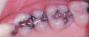 Amalgam Fillings