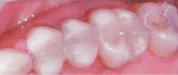 Bonded White Fillings