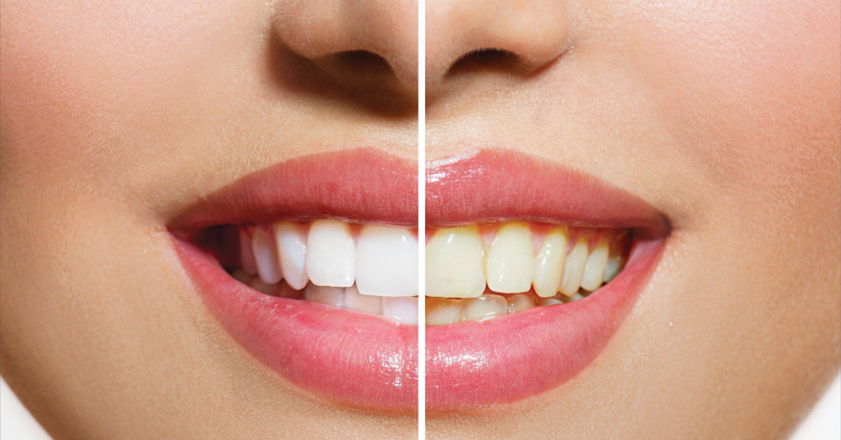 Cosmetic Dentistry Waconia How Whitening Works