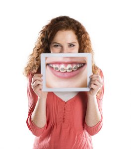 braces