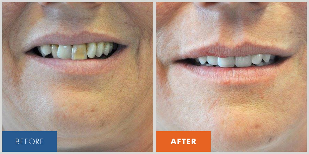 Before And After Affordable Dental Care In Indianapolis