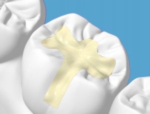fillings-2-300x228