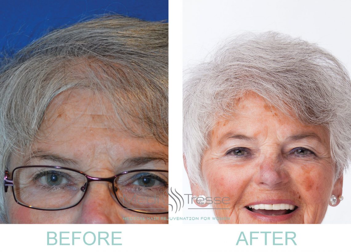 PRP Before and After Photos Medi Tresse Boston