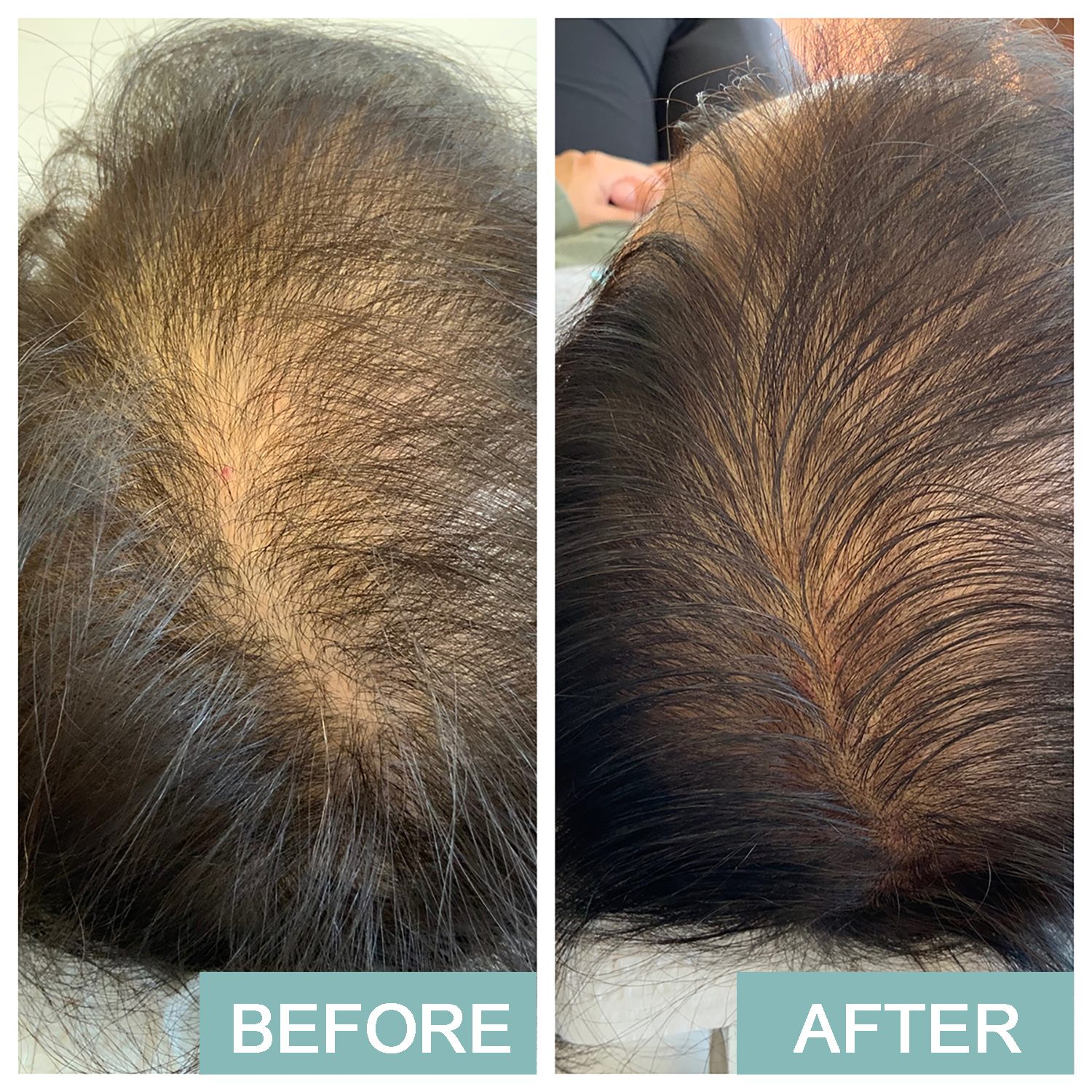 Scalp Micropigmentation & Microblading inar & Live Treatment