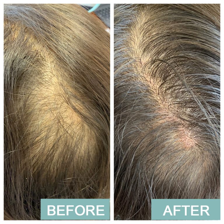 Scalp Micropigmentation & Microblading inar & Live Treatment