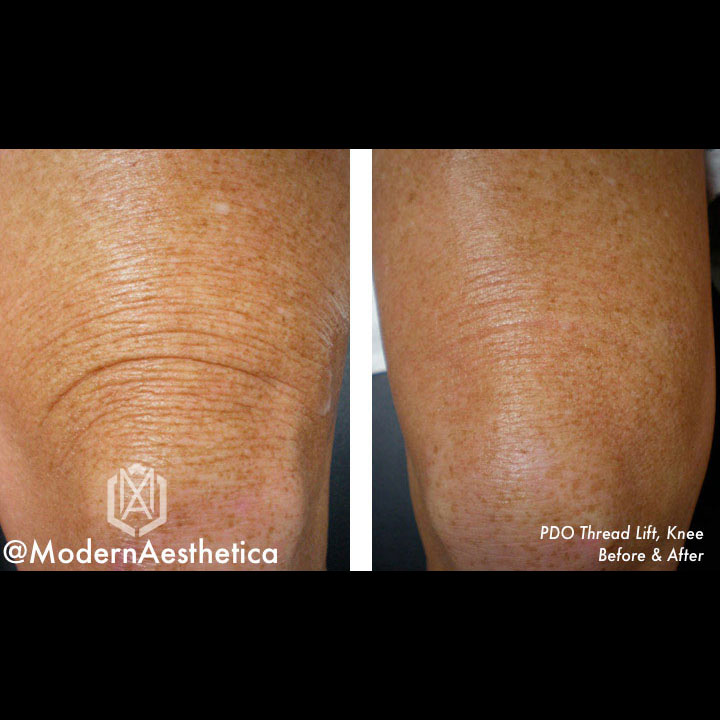 PDO Thread Lift Gallery Modern Aesthetica