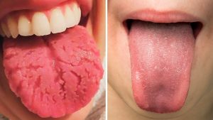 stress bumps on tongue