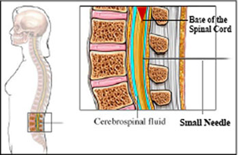 LP involves inserting a small needle between the vertebrae below the base of spinal cord. A small amount of fluid is collected. There is no risk for paralysis.