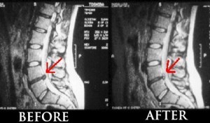 spinal-decompression-before-and-after1-300x175