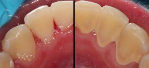 teeth calculus growth rate