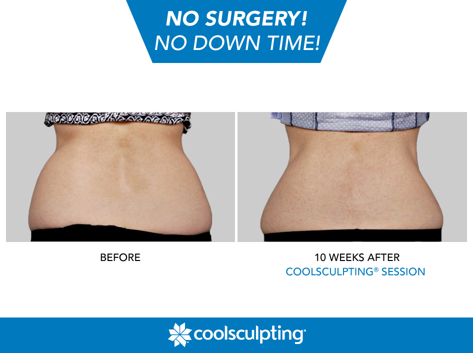 Coolsculpting Love Handles Pic