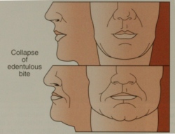 FacialCollapseDiagram facial collapse diagram