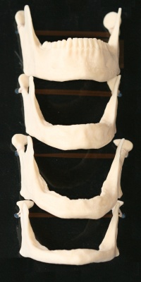 facial-collapse-jawbone-1 Process of facial collapse