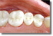 Photo after receiving white fillings, which are available from Colorado springs cosmetic dentist Dr. Joseph Rota.