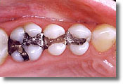 Photo of teeth with amalgam fillings before they were replaced with white fillings, which are available from Colorado Springs cosmetic dentist Dr. Joseph Rota.