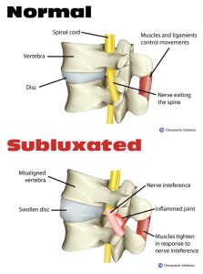 When your discs show signs of wear and tear (degenerative disc disease) they send an alarm and alter function to your body in the form of symptoms.