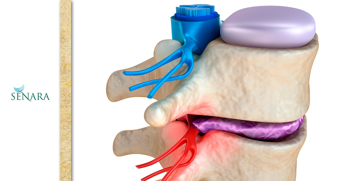 Herniated 2025 disc cushion