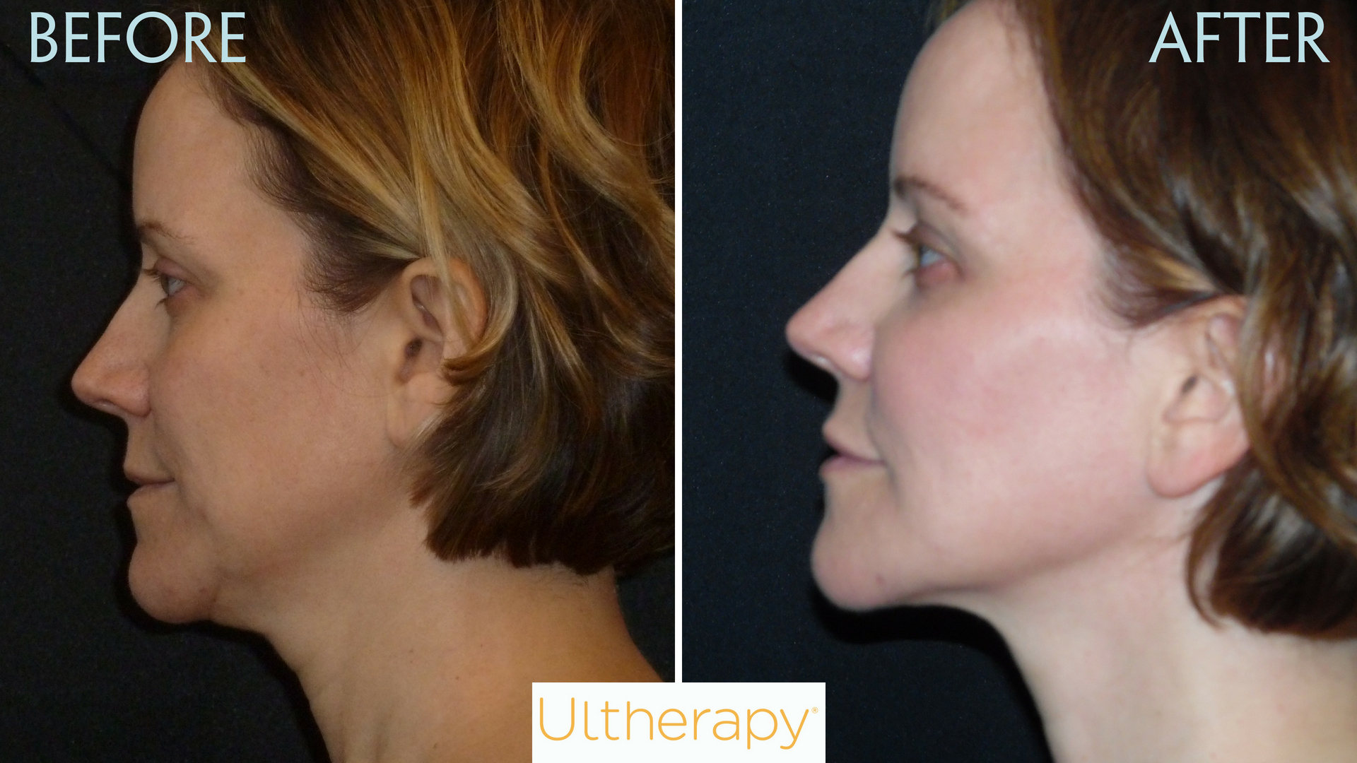 ultherapy cost