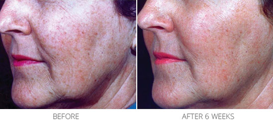 rosacea environ