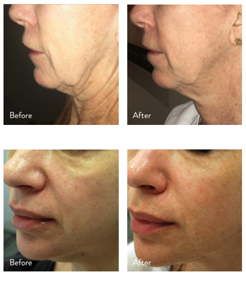 Skin Remodeling With Morpheus8 Skin Care Clinic Nashville Skin Mb