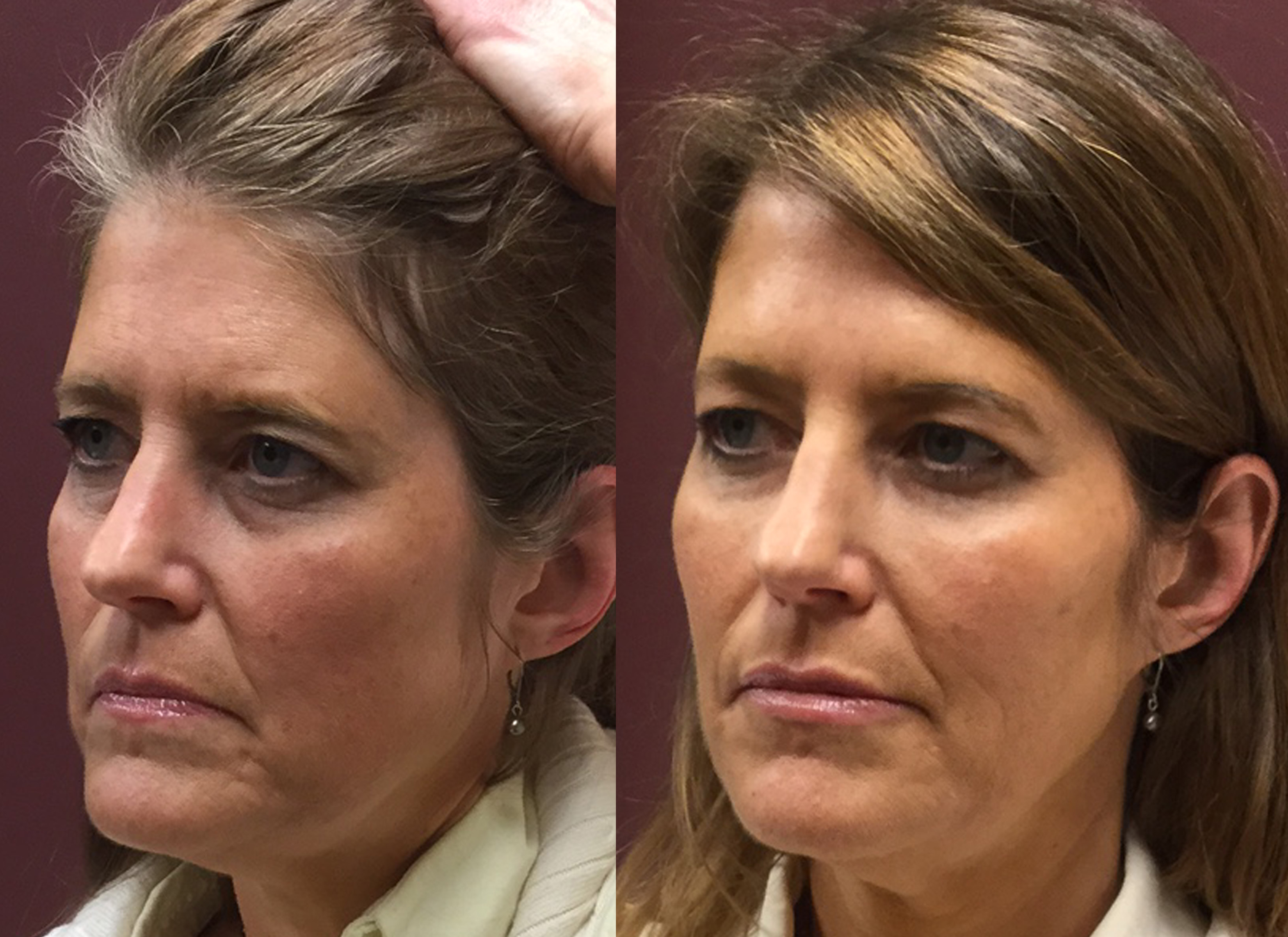 Before After Photo Gallery Skin Rejuvenation Clinic