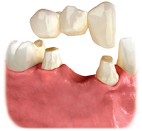 dental-bridge-annapolis