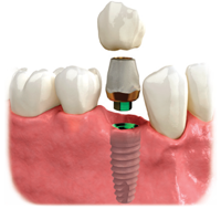 dental-implant-annapolis