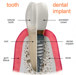 dental-implants-annapolis-250x246