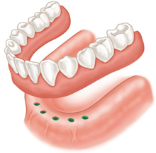 implant-supported-denture-annapolis