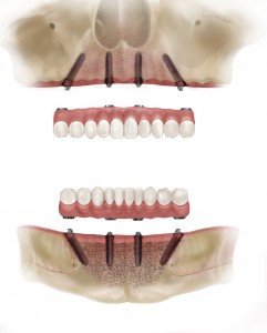 teeth-on-4part2f-241x300