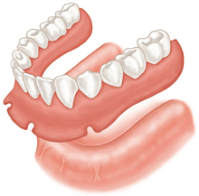 traditional-denture-annapolis