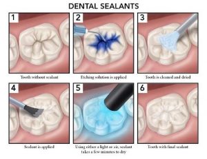 dental sealant process