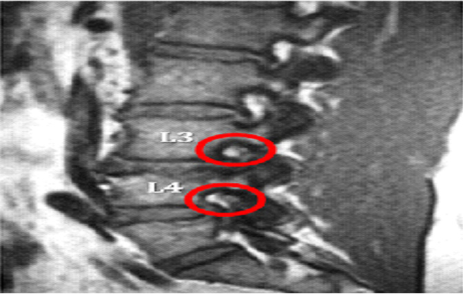 Contact us for relief from foraminal stenosis.
