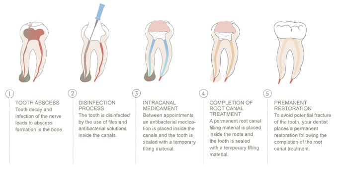 Root Canal Treatment - High Quality Care Made Easy ...