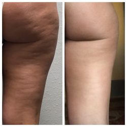 laser fat removal non invasive liposuction superior laser light fat removal