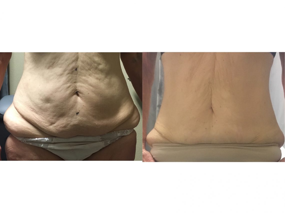 laser fat removal non invasive liposuction superior laser light fat removal