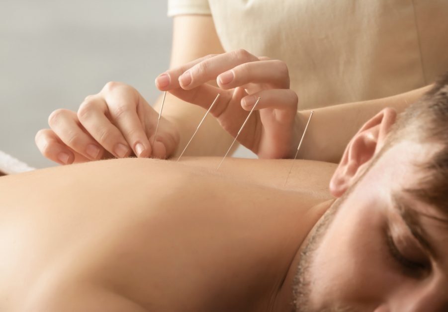 acupuncture 1
