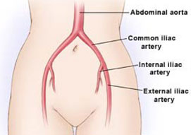 Aorto-Illiac Duplex