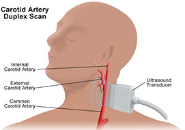 Carotid Artery Duplex