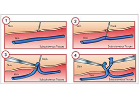 Micro-phlebectomy