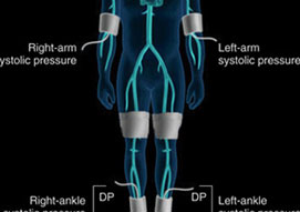 Upper Extremity Arterial Duplex